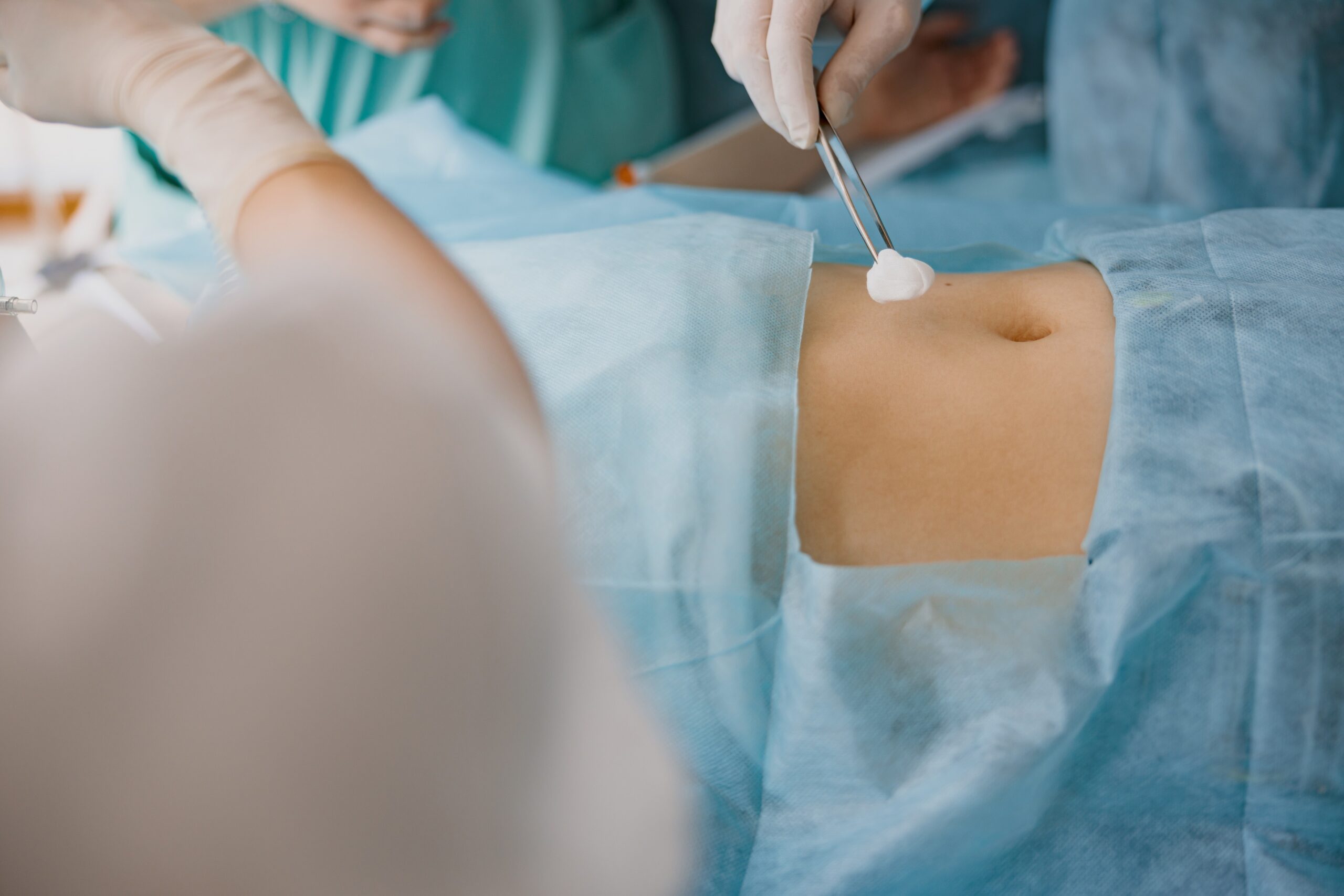 Portfolio: Abdominal Surgeries